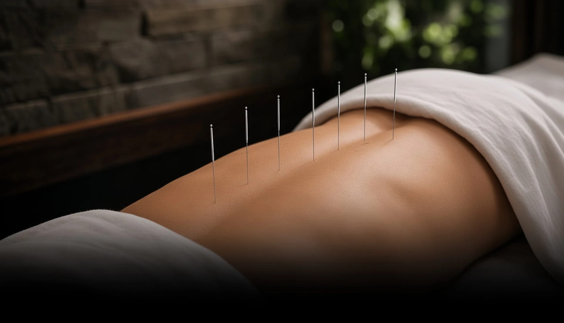 Fine acupuncture needles along the back during a calm treatment at Leela Eco Spa.